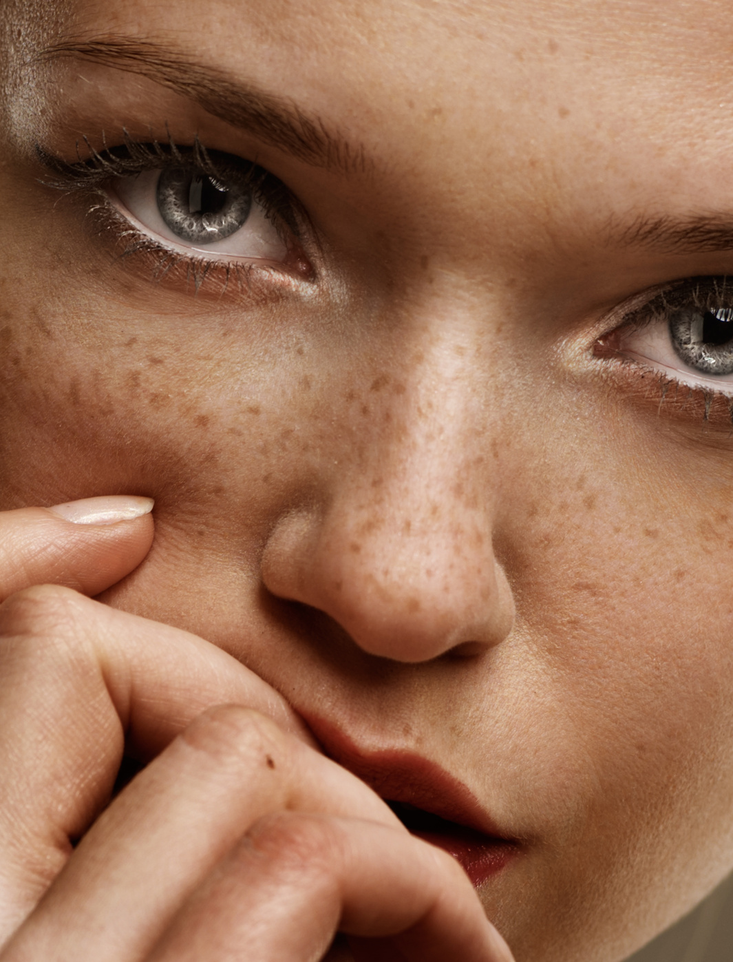 Freckles